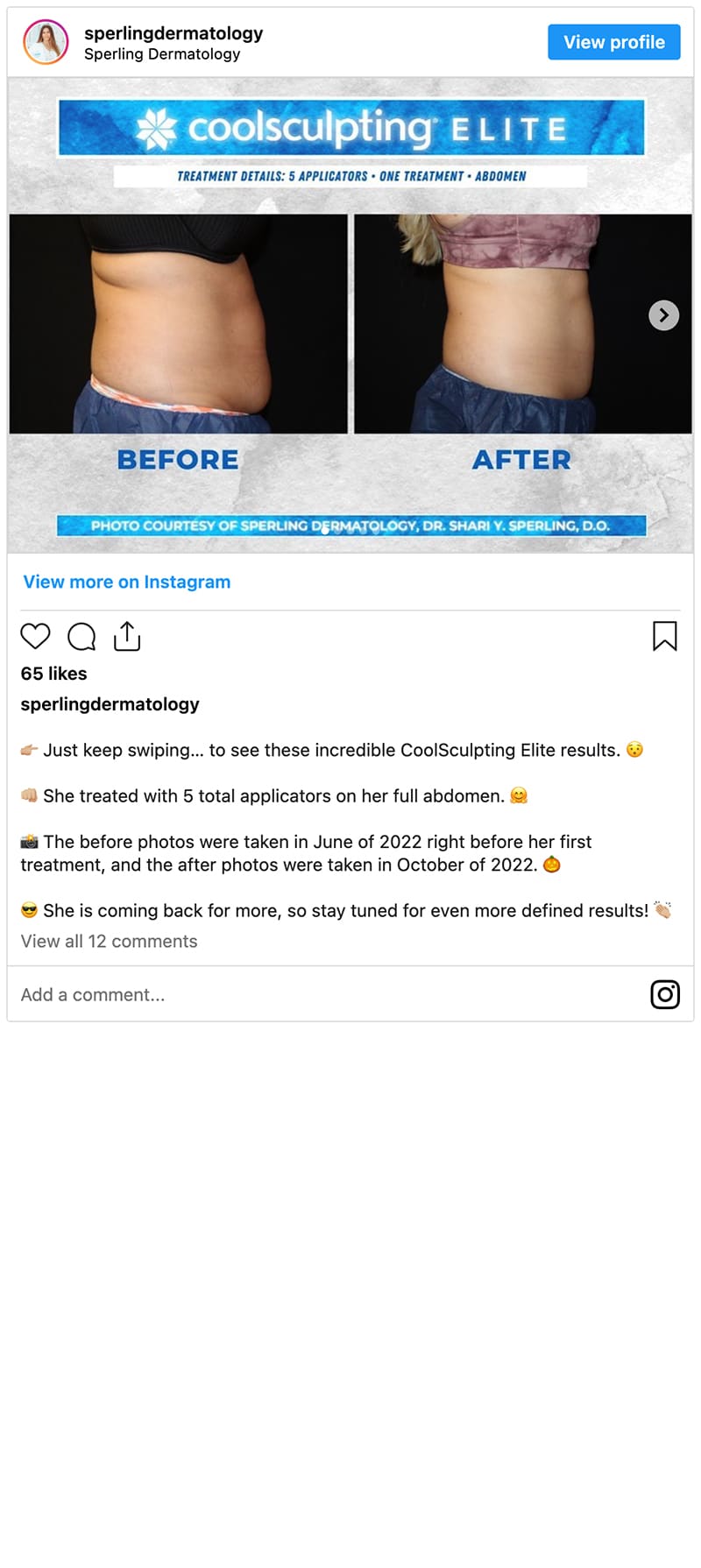 CoolSculpting Elite New Jersey Instagram