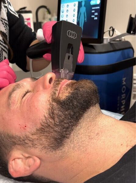 Aesthetic professional administering a Morpheus8 treatment