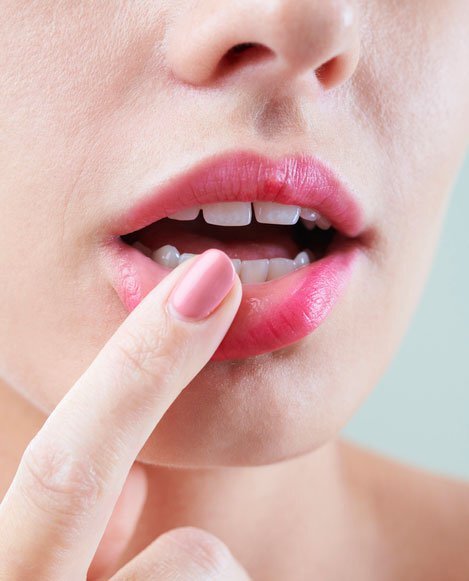 cold sores treatments New Jersey