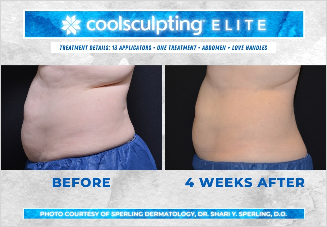 Before & After Abdomen CoolSculpting in New Jersey