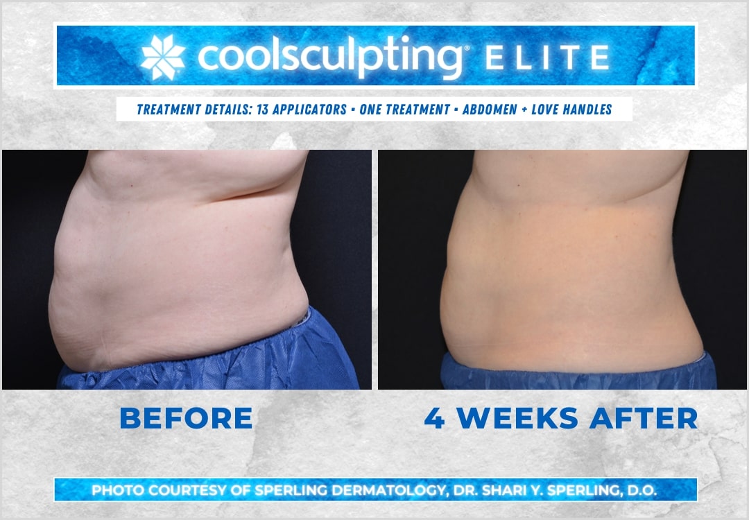 Before & After Abdomen CoolSculpting in New Jersey