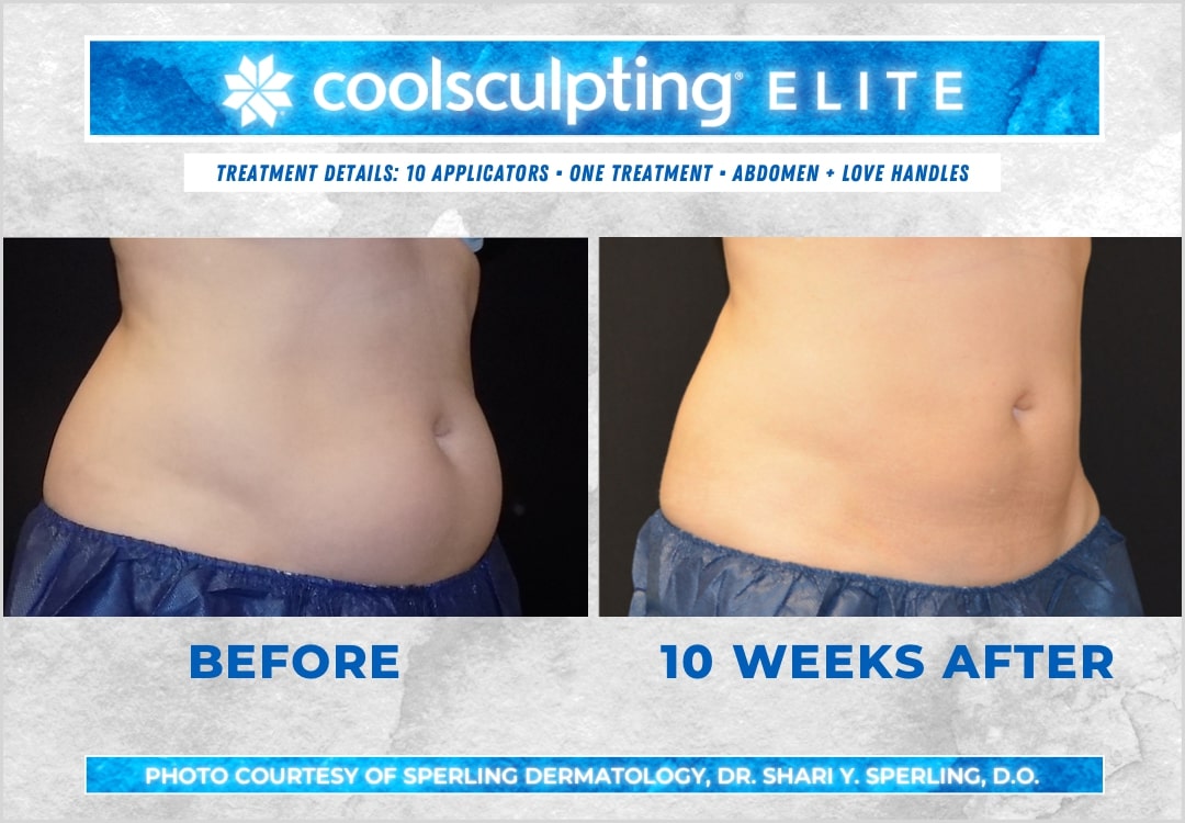 Before & After Abdomen CoolSculpting in New Jersey