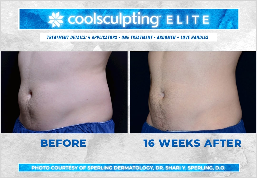 Before & After Abdomen CoolSculpting in New Jersey