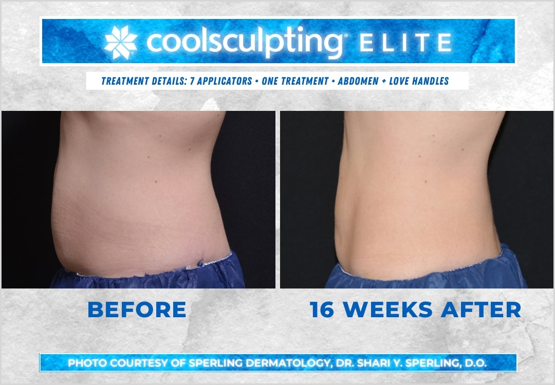 Before & After Abdomen CoolSculpting in New Jersey