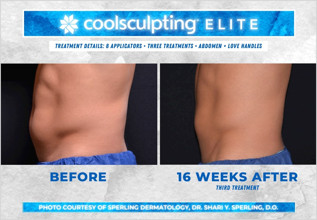 Before & After Abdomen CoolSculpting in New Jersey