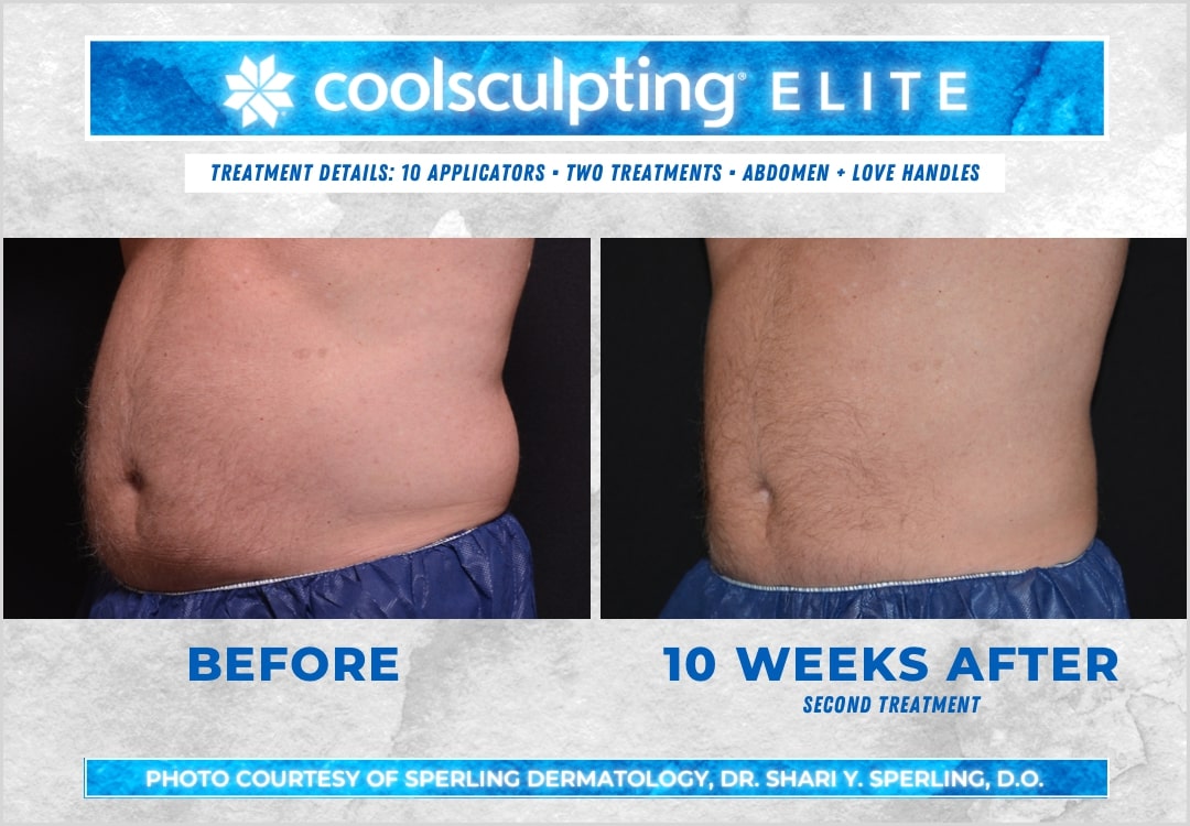 Before & After Abdomen CoolSculpting in New Jersey