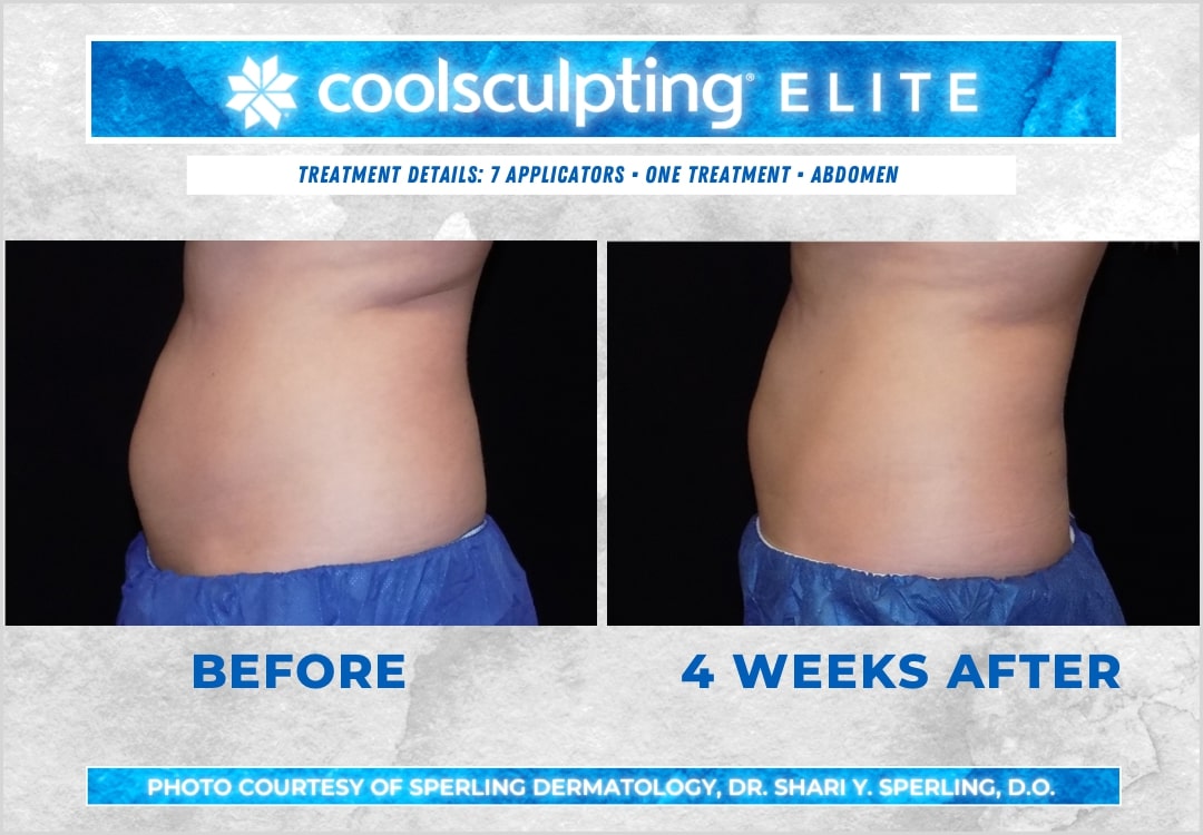 Before & After Abdomen CoolSculpting in New Jersey