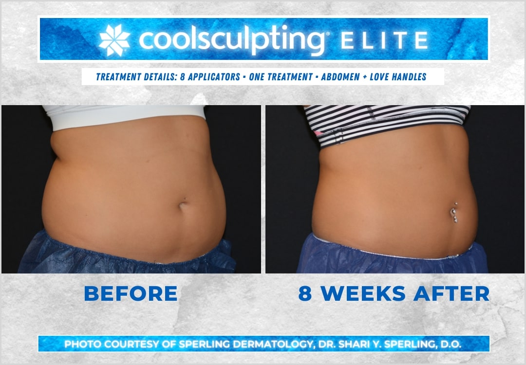 Before & After Abdomen CoolSculpting in New Jersey