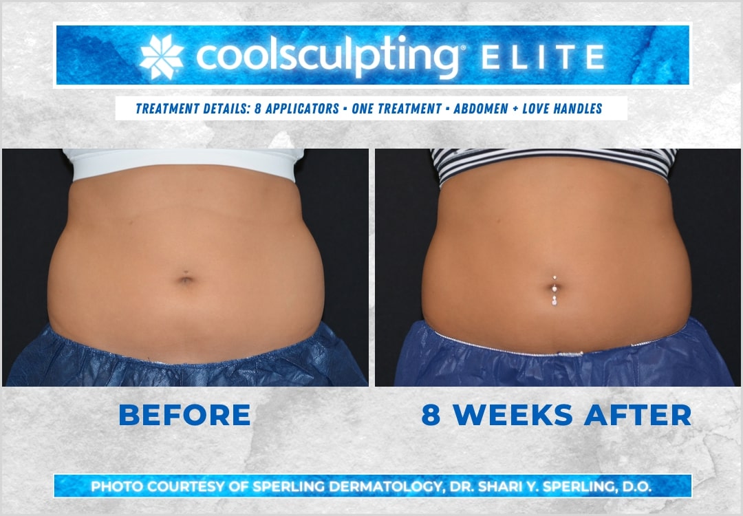 Before & After Abdomen CoolSculpting in New Jersey