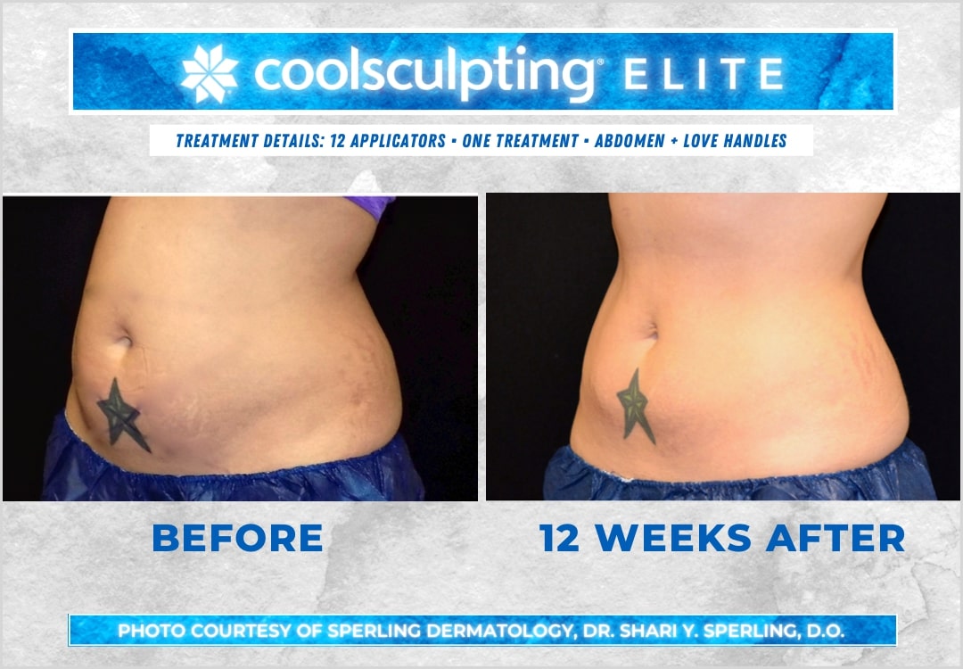 Before & After Abdomen CoolSculpting in New Jersey