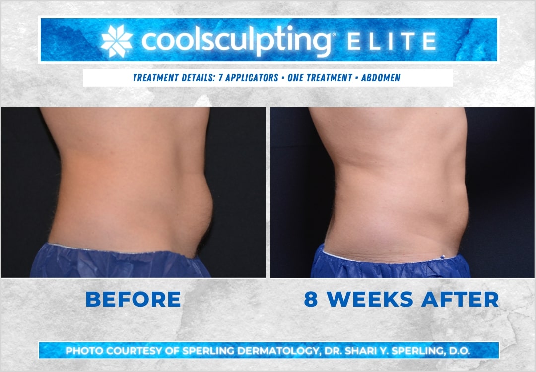 Before & After Abdomen CoolSculpting in New Jersey