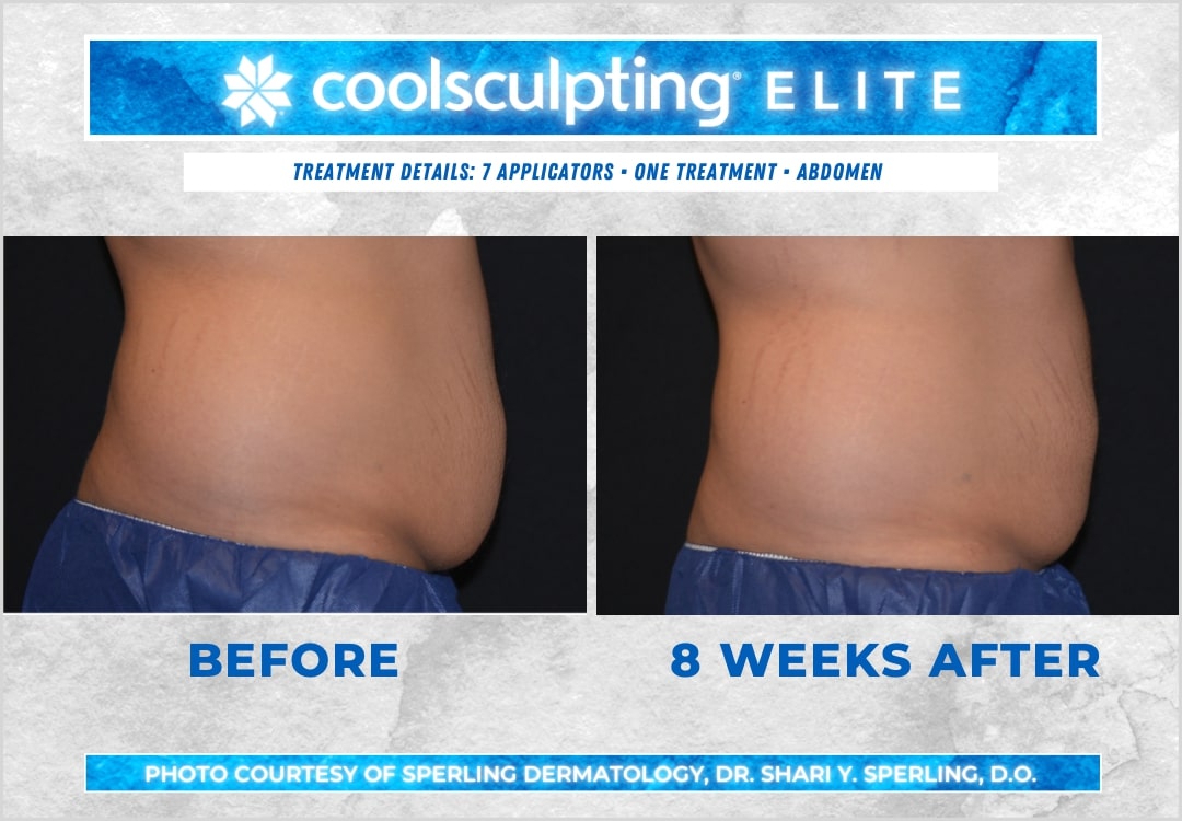 Before & After Abdomen CoolSculpting in New Jersey