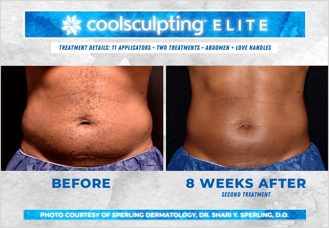 Before & After Abdomen CoolSculpting in New Jersey