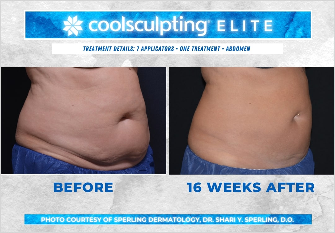 Before & After Abdomen CoolSculpting in New Jersey