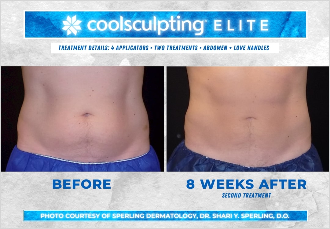 Before & After Abdomen CoolSculpting in New Jersey