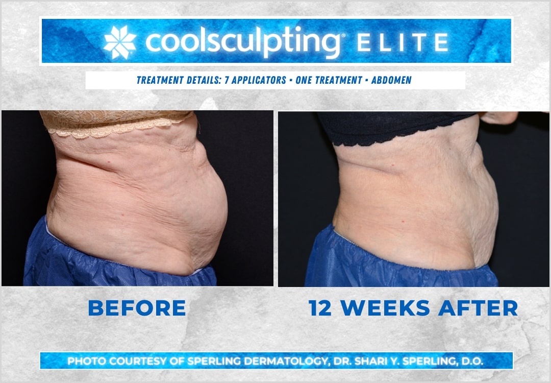 Before & After Abdomen CoolSculpting in New Jersey