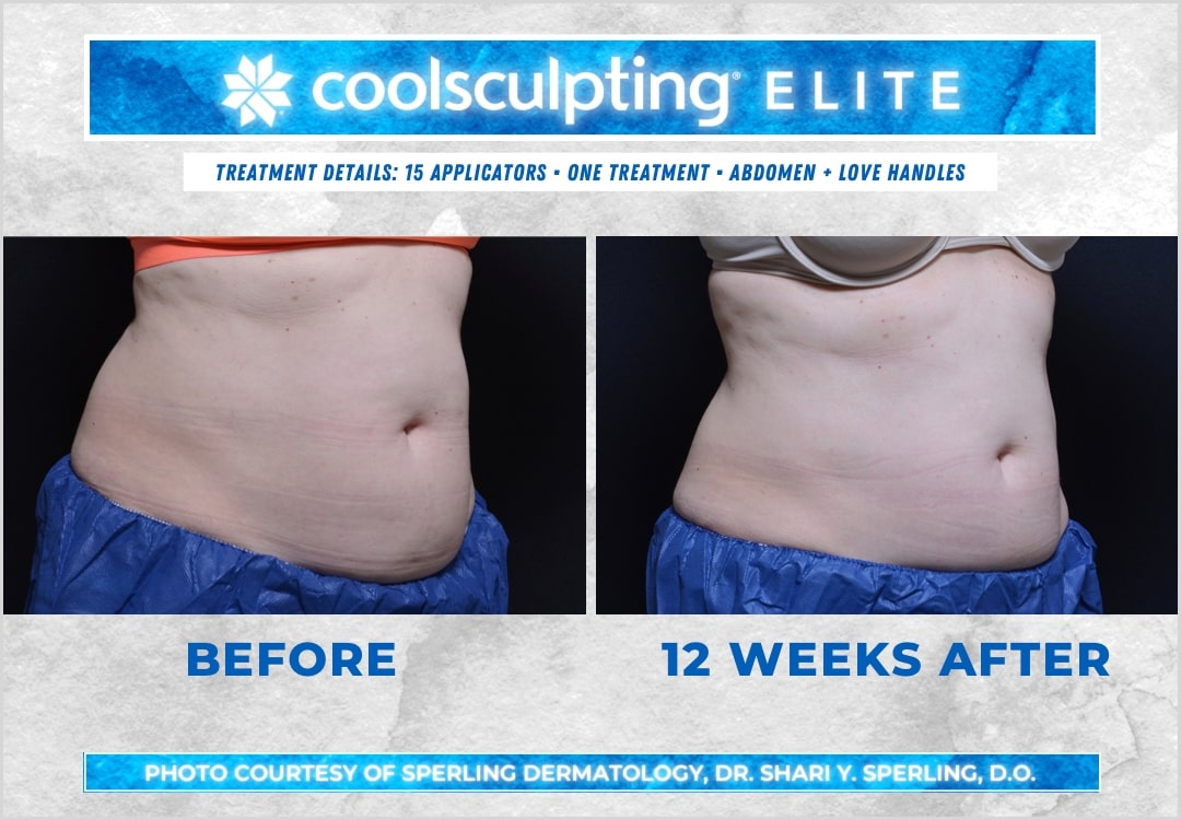 Before & After Abdomen CoolSculpting in New Jersey