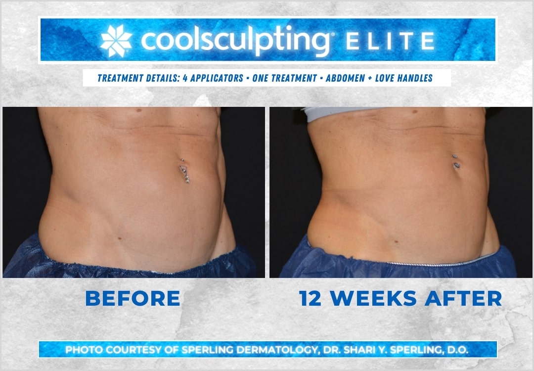 Before & After Abdomen CoolSculpting in New Jersey