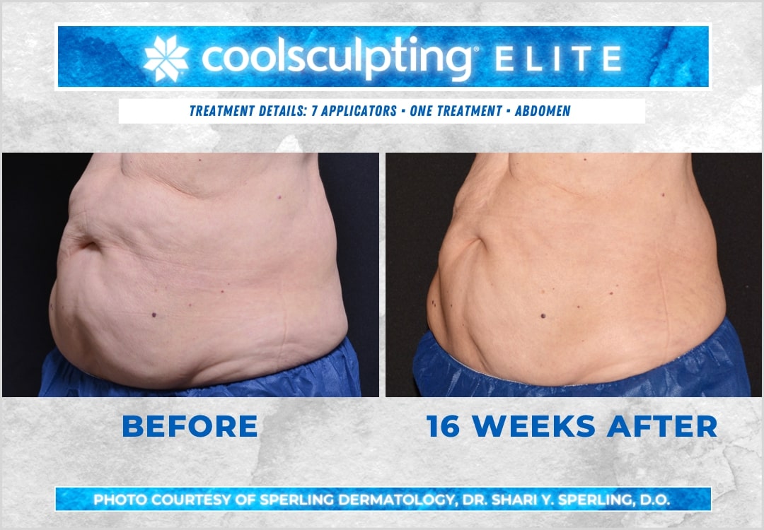 Before & After Abdomen CoolSculpting in New Jersey