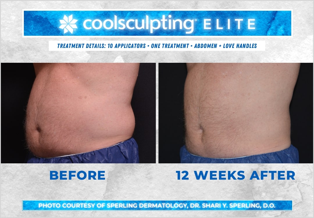 Before & After Abdomen CoolSculpting in New Jersey