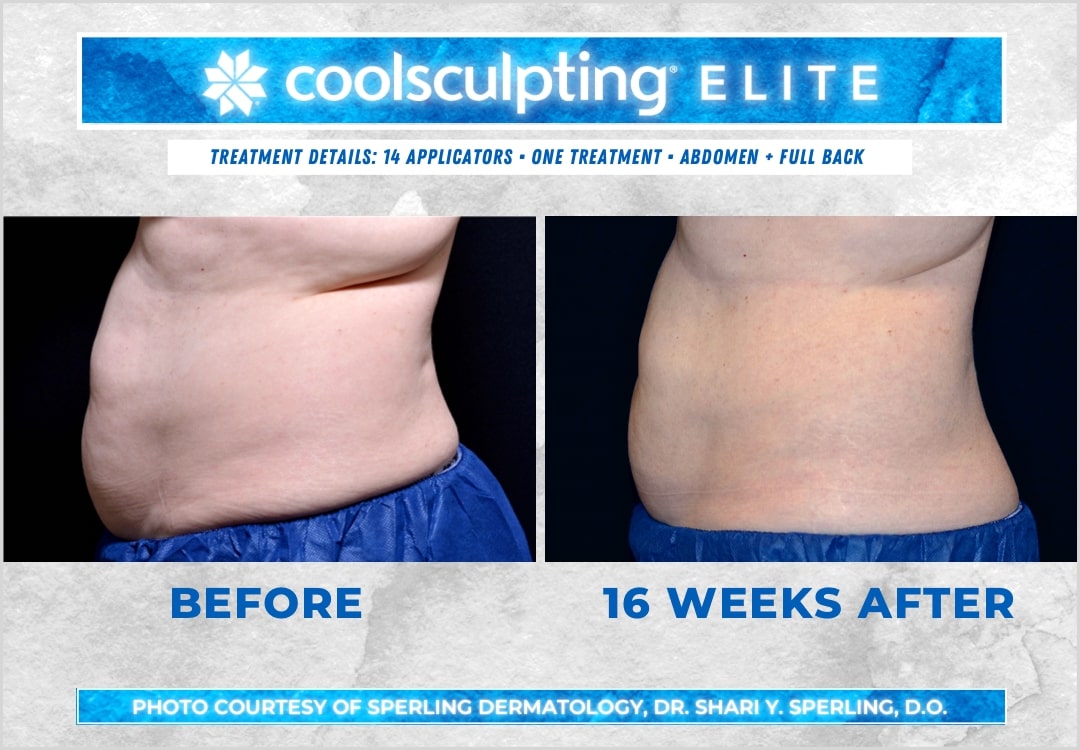 Before & After Abdomen CoolSculpting in New Jersey