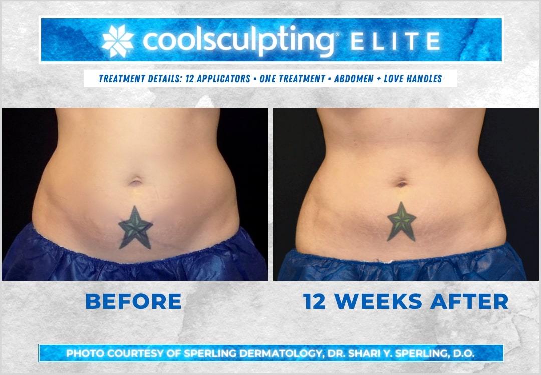 Before & After Abdomen CoolSculpting in New Jersey