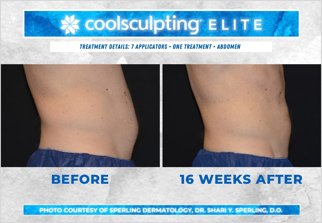 Before & After Abdomen CoolSculpting in New Jersey