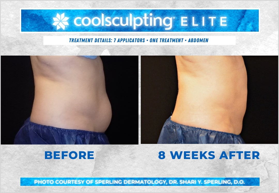 Before & After Abdomen CoolSculpting in New Jersey