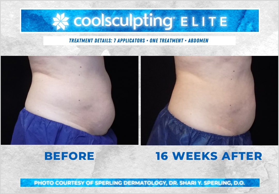 Before & After Abdomen CoolSculpting in New Jersey