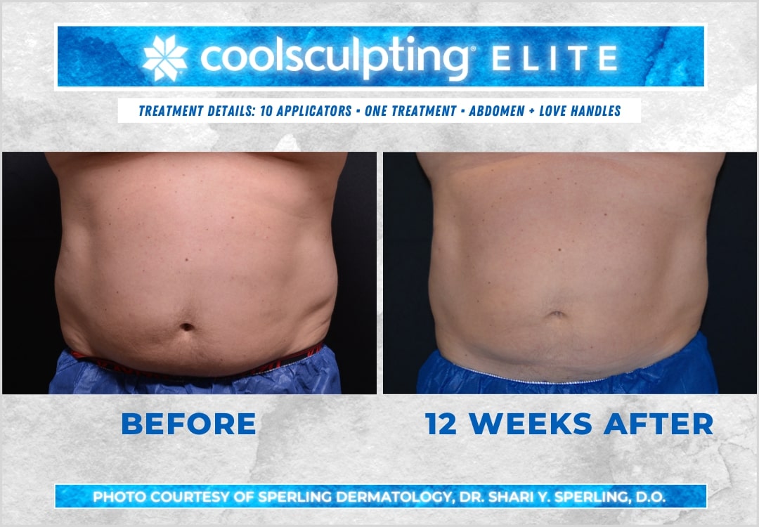 Before & After Abdomen CoolSculpting in New Jersey