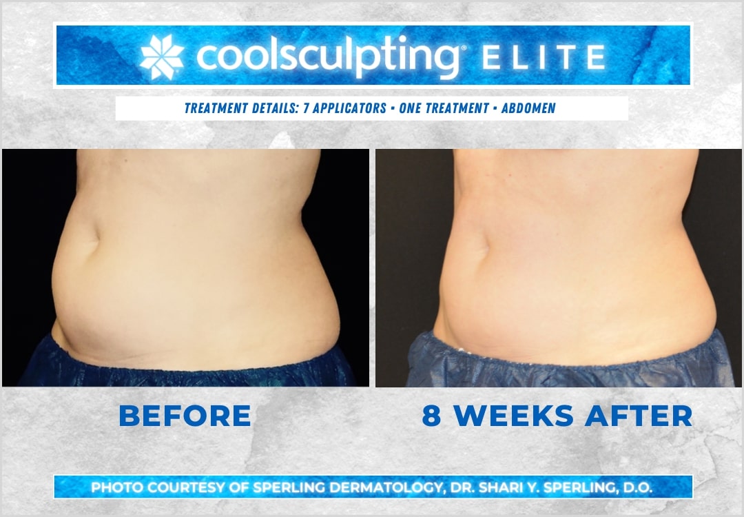 Before & After Abdomen CoolSculpting in New Jersey