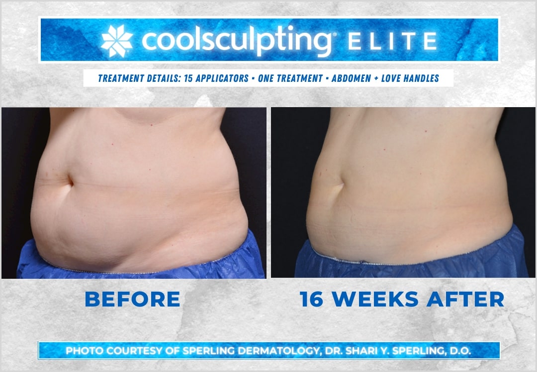 Before & After Abdomen CoolSculpting in New Jersey