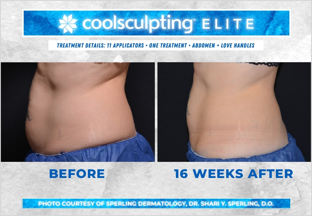 Before & After Abdomen CoolSculpting in New Jersey