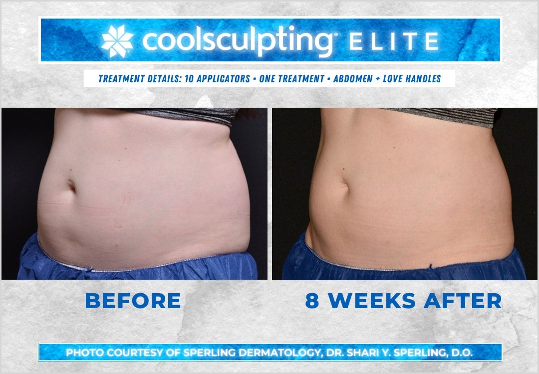 Before & After Abdomen CoolSculpting in New Jersey