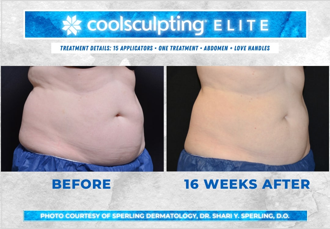 Before & After Abdomen CoolSculpting in New Jersey