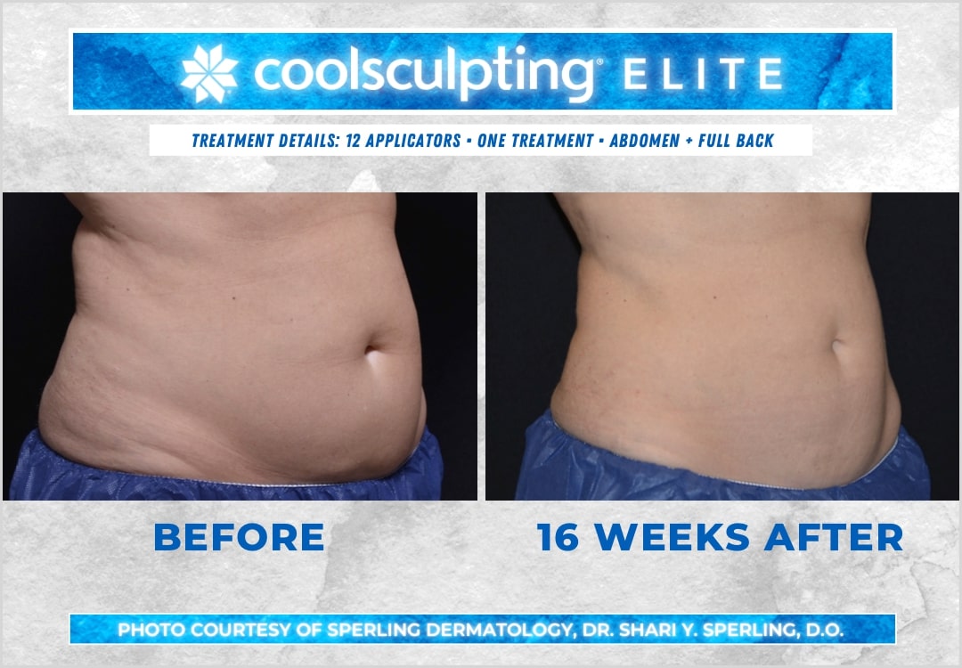 Before & After Abdomen CoolSculpting in New Jersey