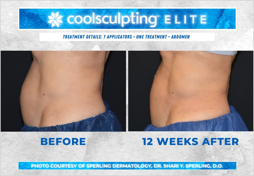 Before & After Abdomen CoolSculpting in New Jersey