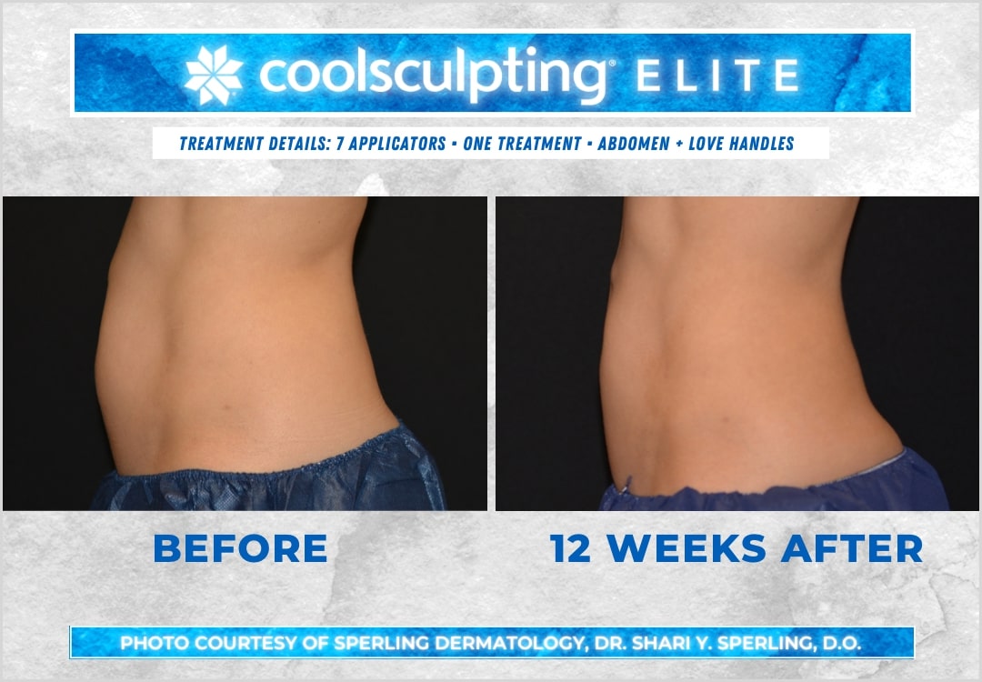 Before & After Abdomen CoolSculpting in New Jersey