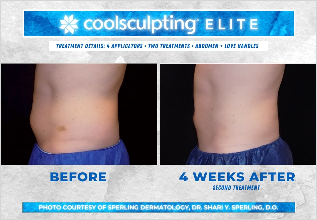 Before & After Abdomen CoolSculpting in New Jersey