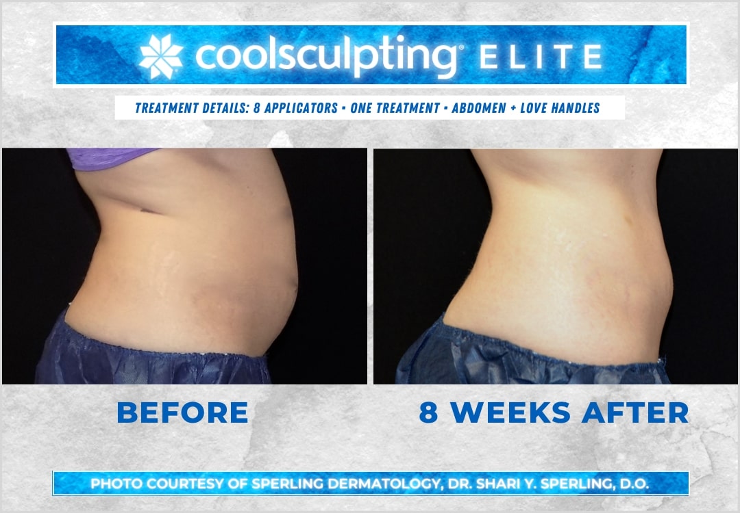 Before & After Abdomen CoolSculpting in New Jersey