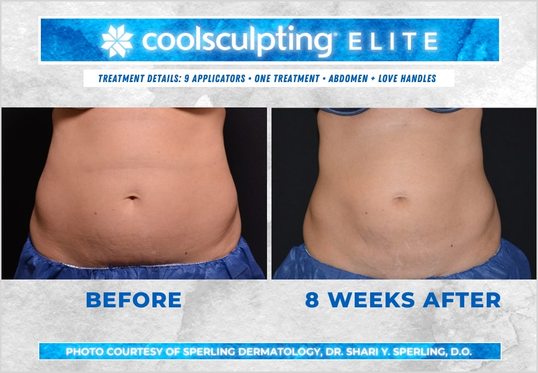 Before & After Abdomen CoolSculpting in New Jersey