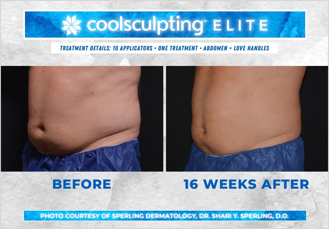 Before & After Abdomen CoolSculpting in New Jersey