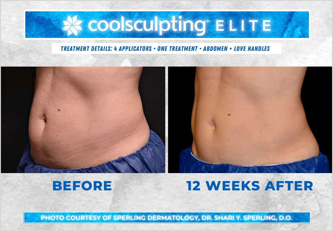 Before & After Abdomen CoolSculpting in New Jersey