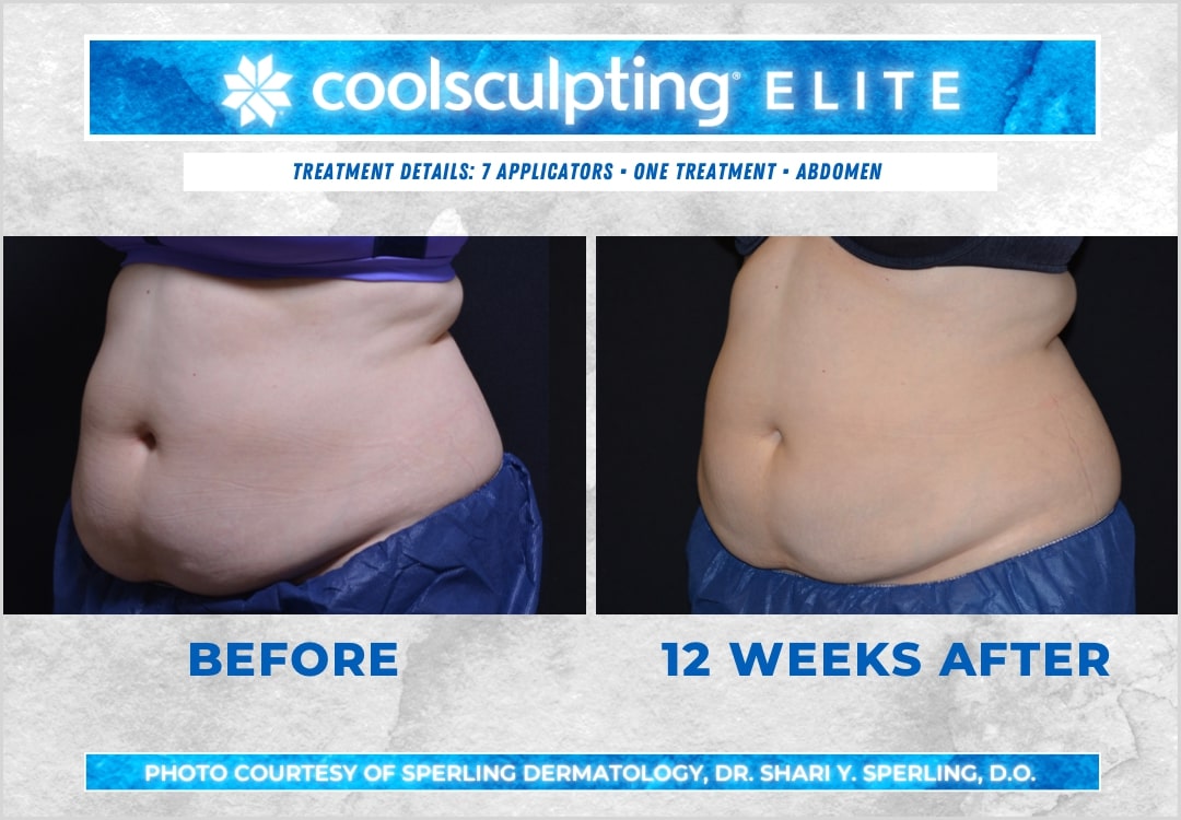 Before & After Abdomen CoolSculpting in New Jersey