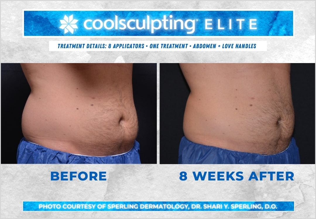 Before & After Abdomen CoolSculpting in New Jersey