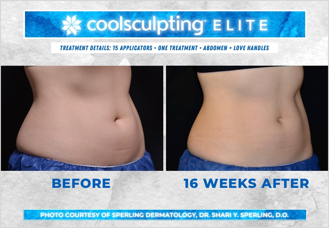 Before & After Abdomen CoolSculpting in New Jersey