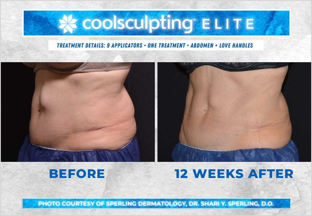 Before & After Abdomen CoolSculpting in New Jersey