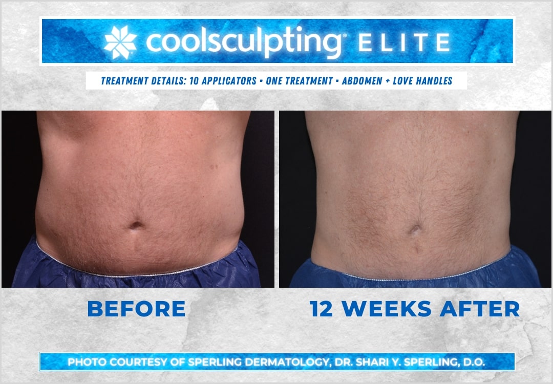 Before & After Abdomen CoolSculpting in New Jersey