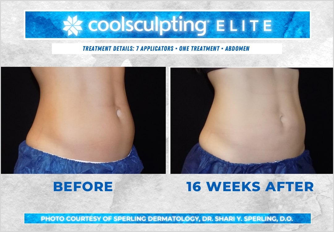 Before & After Abdomen CoolSculpting in New Jersey