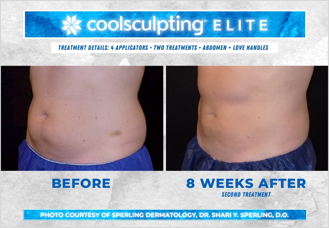 Before & After Abdomen CoolSculpting in New Jersey